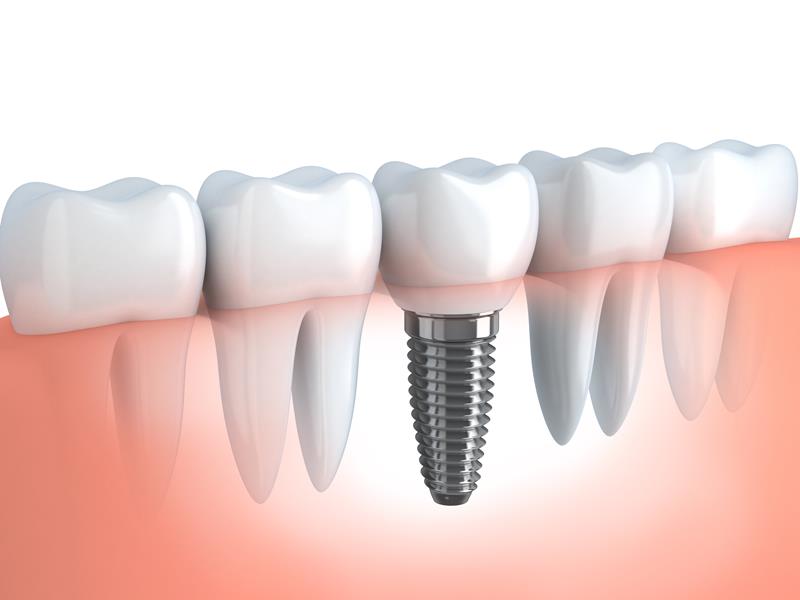 Dental Implants Mt Vernon, NY