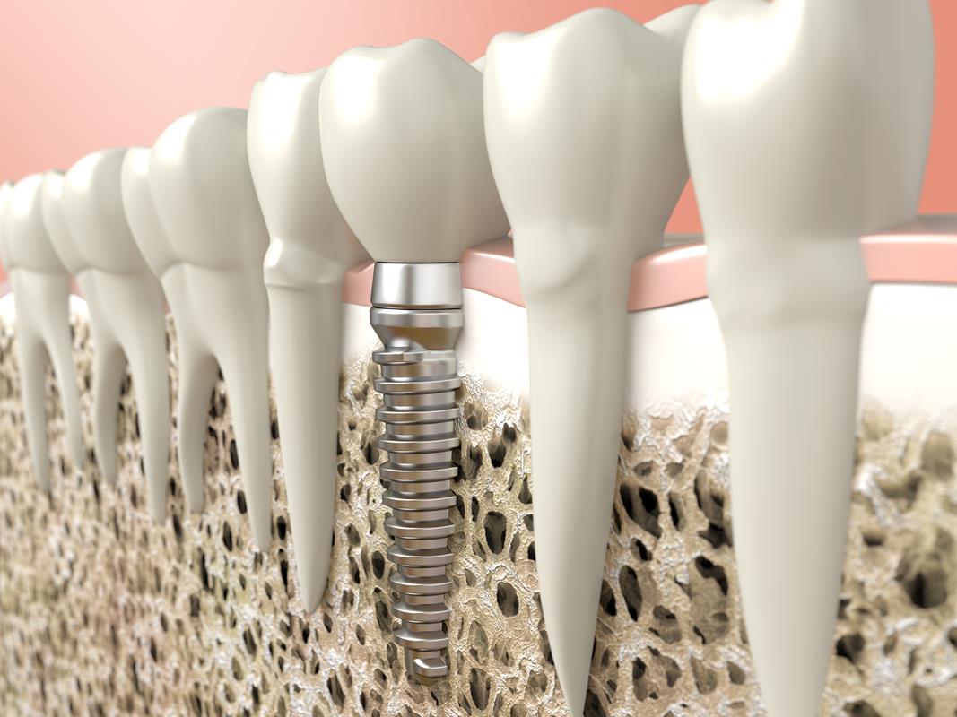 Dental Implants Mt Vernon, NY